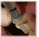 PMTC 歯石除去